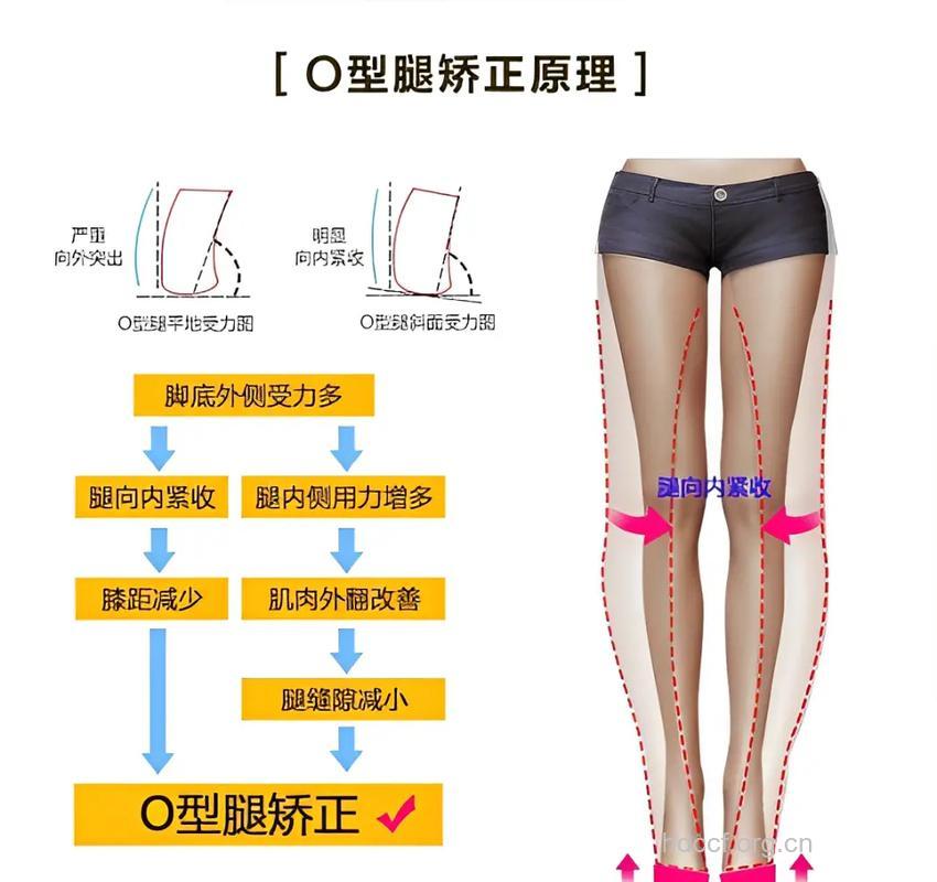 如何矫正O型腿