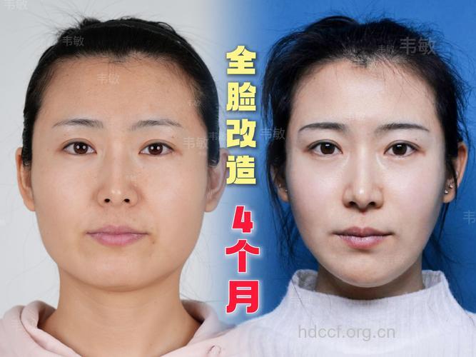 盘点改变脸型七种手术