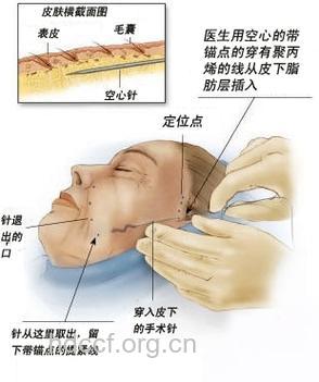面部手术除皱方法汇总