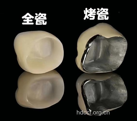 什么是钴铬烤瓷牙