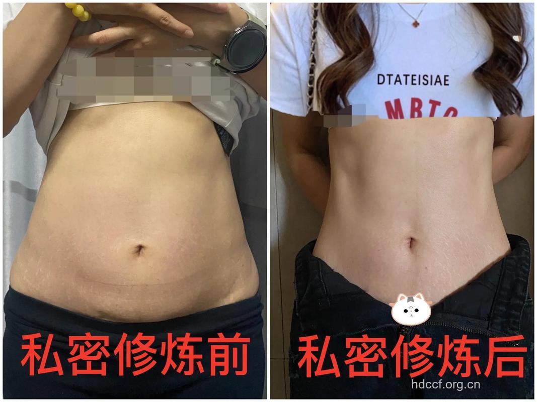 老婆产后做私处整形 老公怎么看