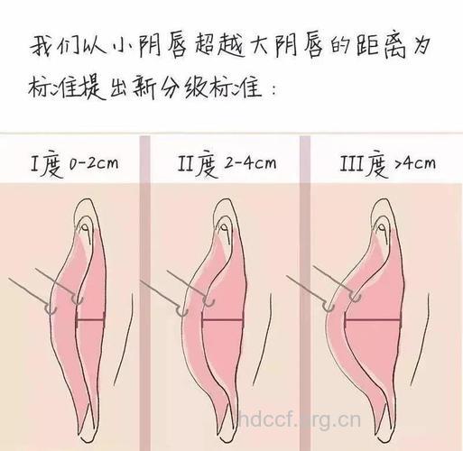 女性生殖整形术的三大急不得
