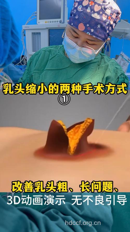乳晕改小手术 让双乳更年轻