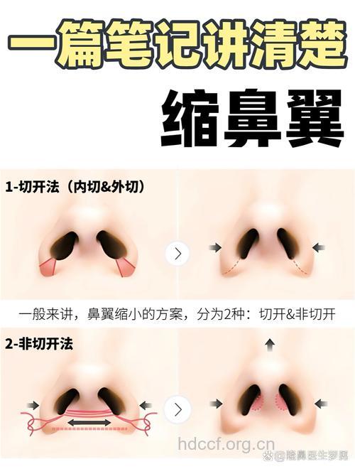 鼻翼缩小手术远离蒜头鼻