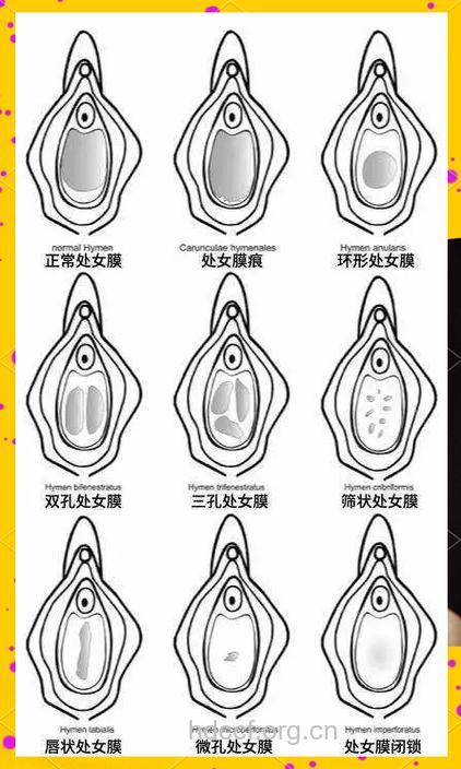 处女与处女膜之间是不对等的