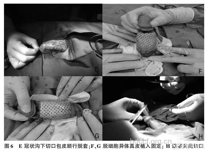 让男人重振雄风的整形手术