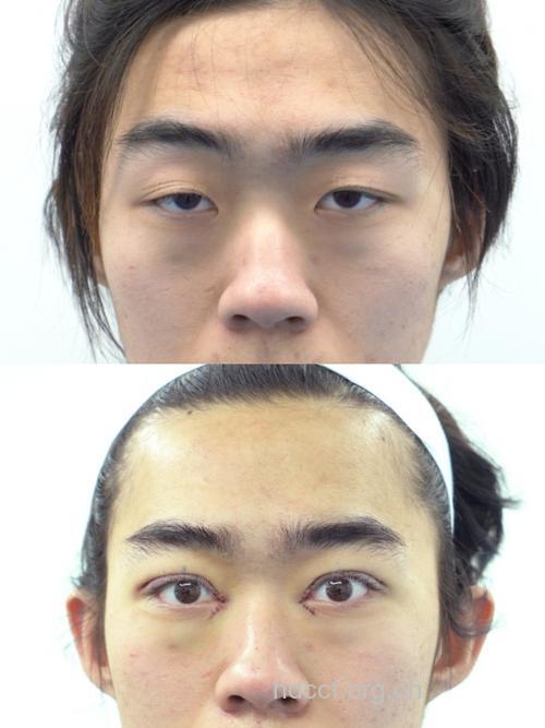 男人40 眼部整形不可小看