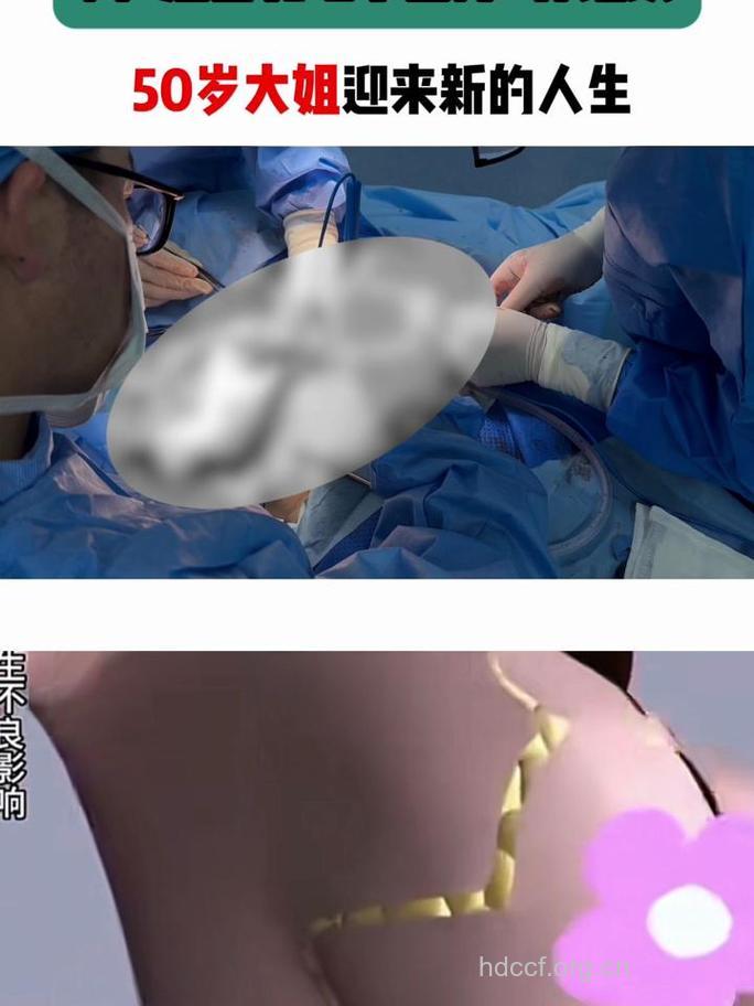 乳晕整形手术让性感集于一处