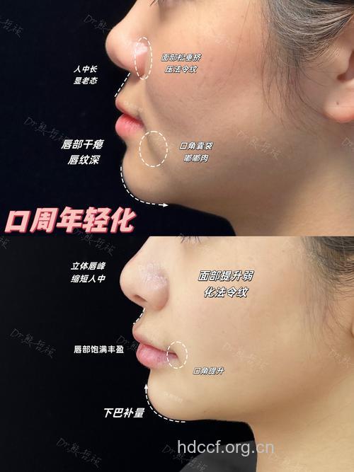 口唇美容整形最常见的五大问题