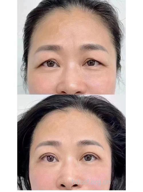 让人更年轻的提眉术有哪几种