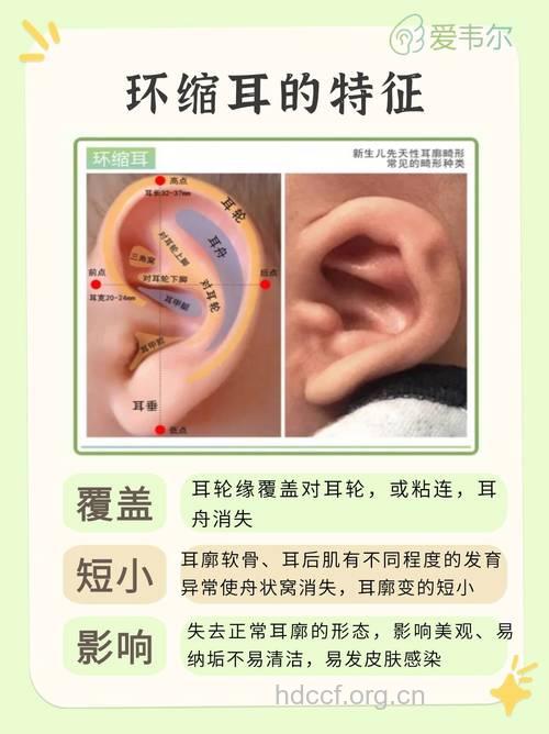 男人耳朵整形的小常识必知