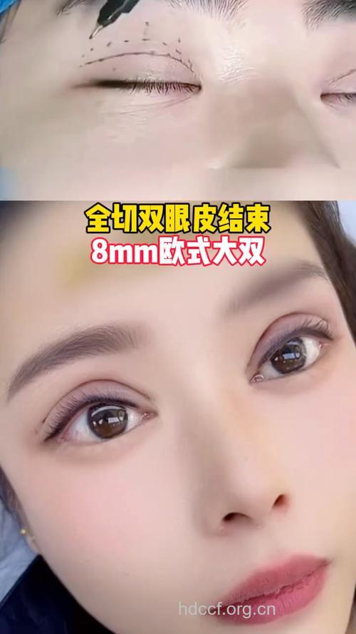 眼皮整形术 还你美丽双眼