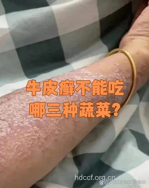 吃蔬菜也会患皮炎吗?
