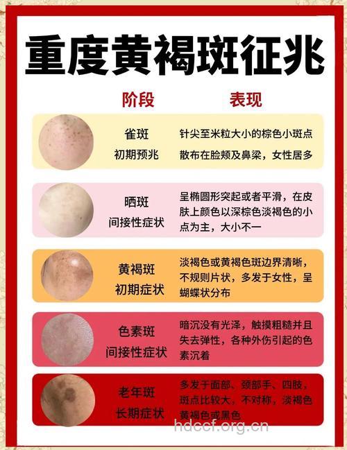 白皙女人脸上出现黑斑怎么办