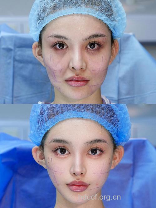 微创面部提升效果咋样呢?