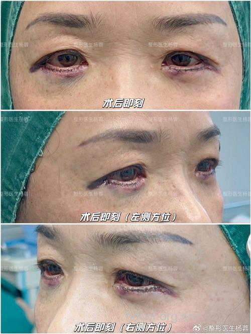 眼部除皱手术 让眼睛更精神