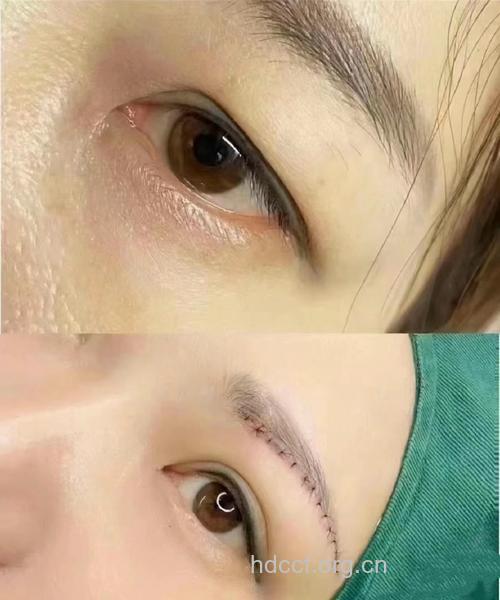 让你年轻10岁的眉角提升手术