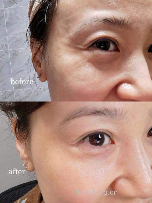 玻尿酸除皱的手术效果怎么样？