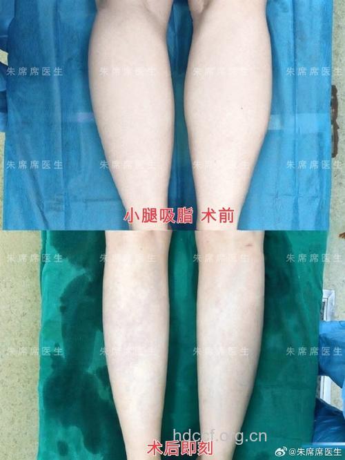 瘦小腿 360度环形吸脂术