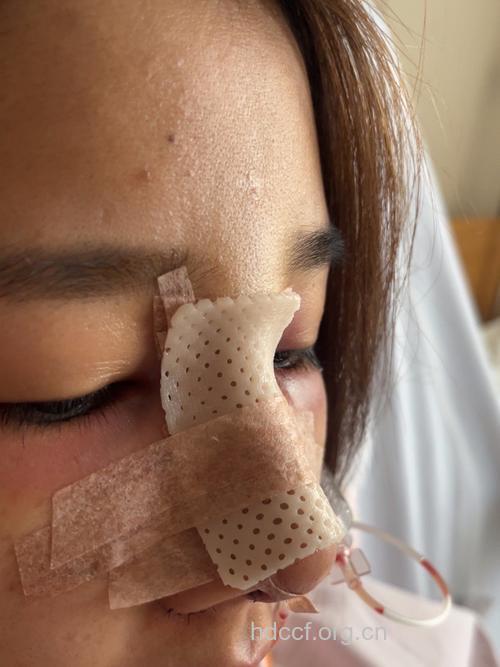 隆鼻后需要多久恢复？