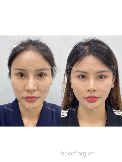 面部提升术适合什么样的人？