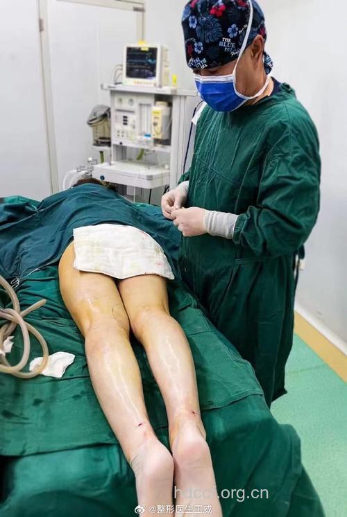 快速瘦小腿的吸脂手术