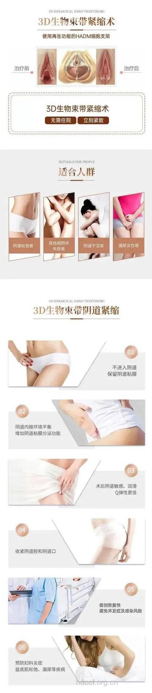 阴道紧缩术 你适合做吗？