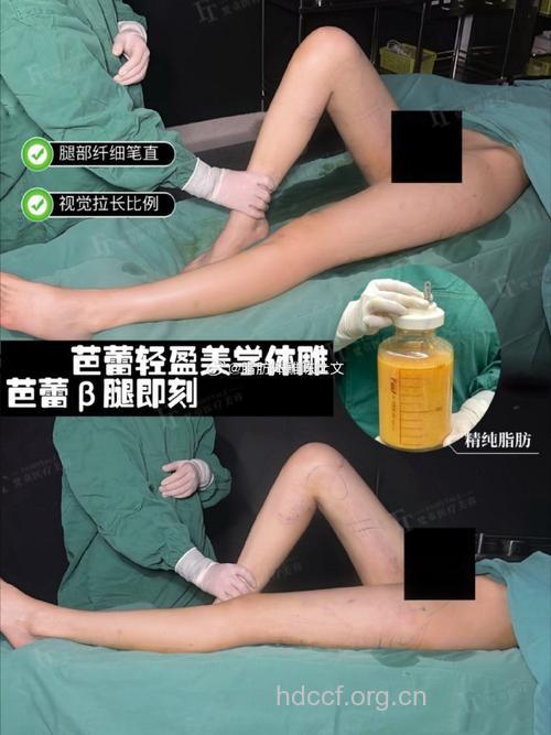 大腿吸脂手术有啥优点？