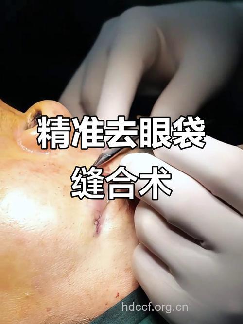 祛除眼袋的外切法手术