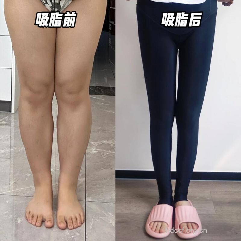 腿部吸脂 打造迷人的双腿