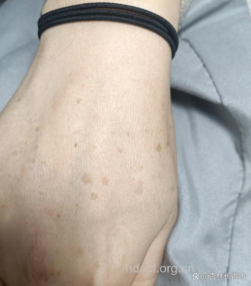 吃菇可以少长老年斑