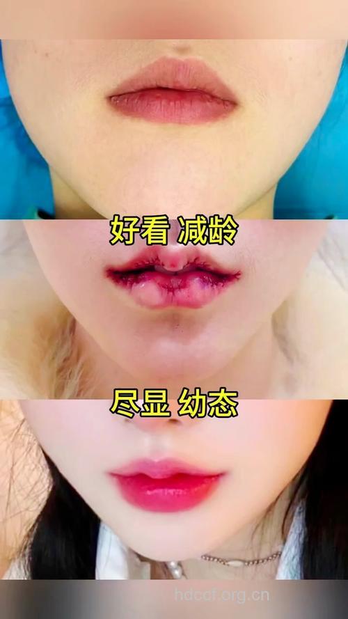 做唇部手术的前后注意