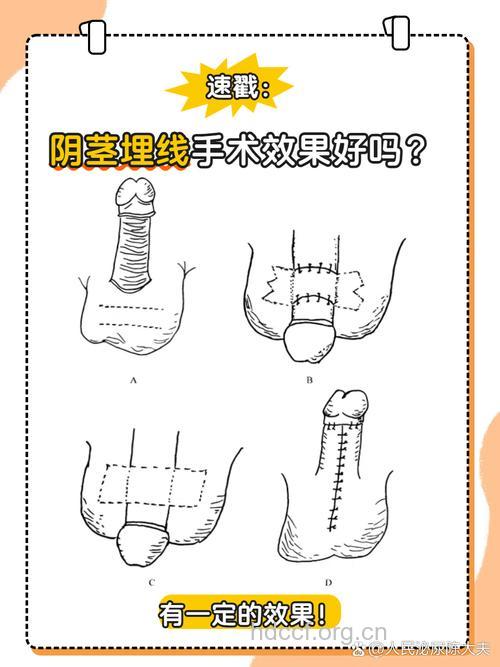 男人做私密整形的7大情况