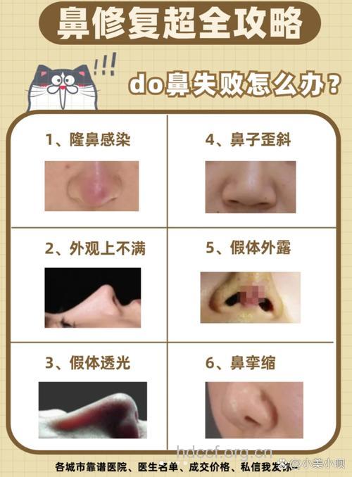 导致隆鼻失败的5个原因