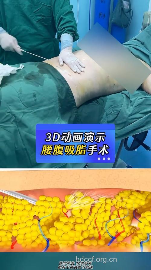 变小蛮腰的腰腹部吸脂手术
