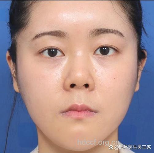 5次手术好鼻子整成＂朝天椒＂