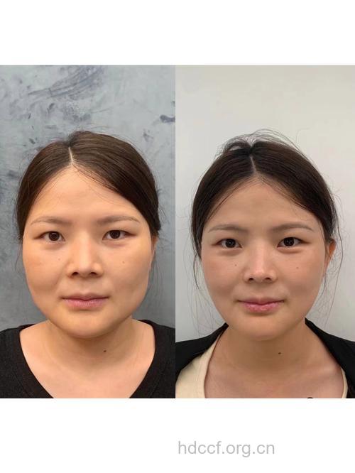 揭密瘦脸整形之六大“最”