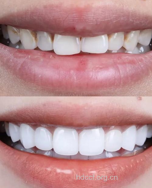 流行的牙齿美白法大盘点