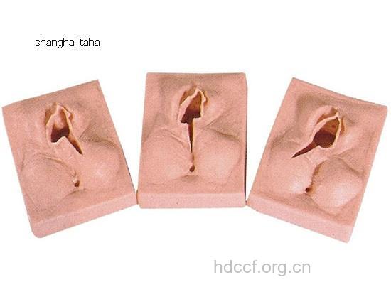 哪些情况说明阴道整形术失败？