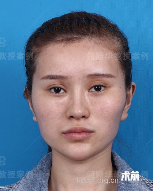 整形攻略：颧骨缩小的全过程