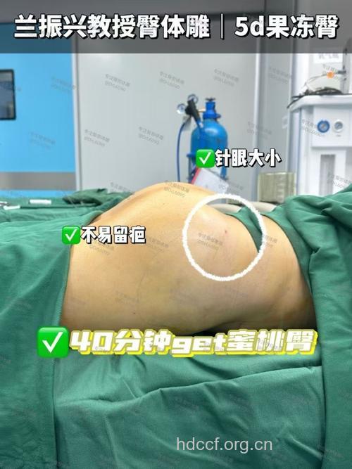玻尿酸注射 无副作用丰臀术