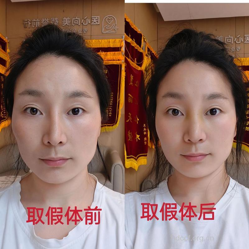 隆鼻假体也可以取出吗?