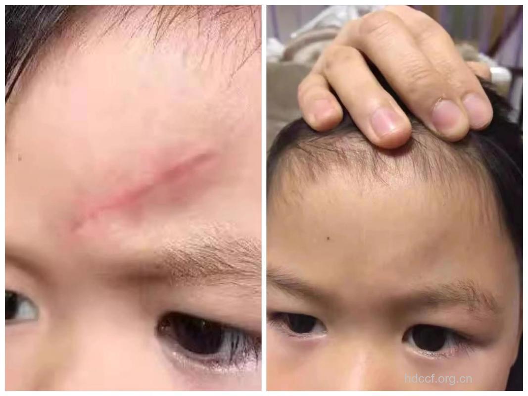 网友口述整形祛疤的完美经历