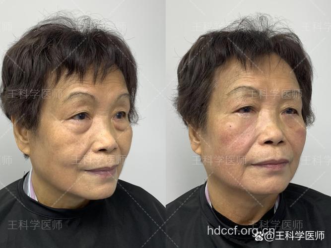不同年龄的祛眼袋整形术