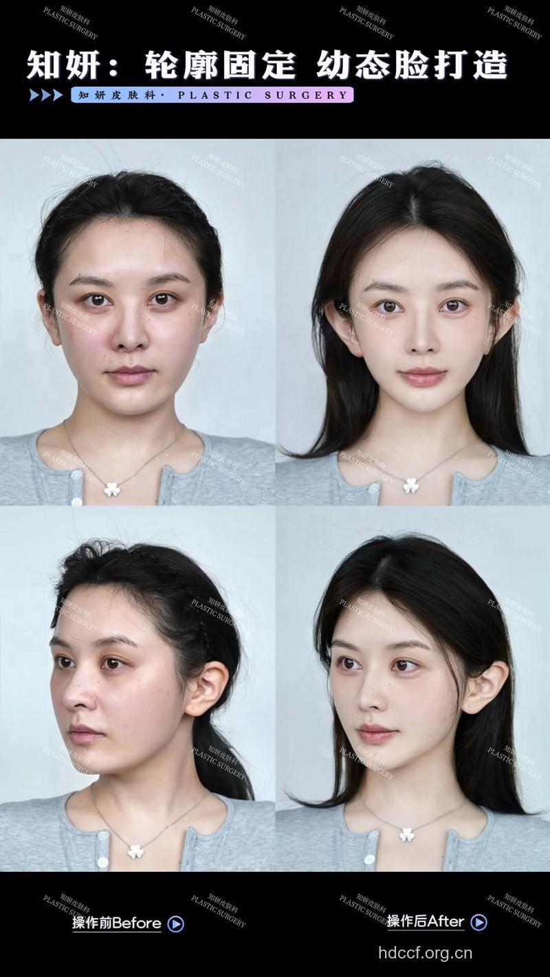 面部提升术的抗衰效果如何?