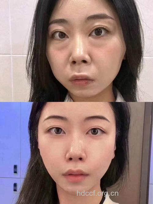 美得自然 微整形的"时光定格术"