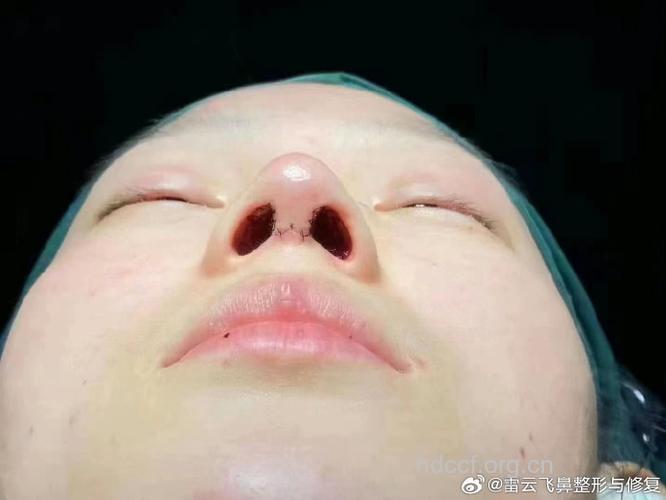 无痕隆鼻的切口在哪里?