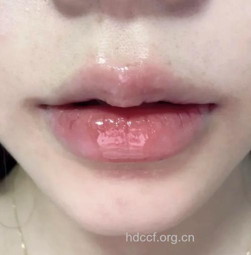 凝胶丰唇 小心成香肠唇