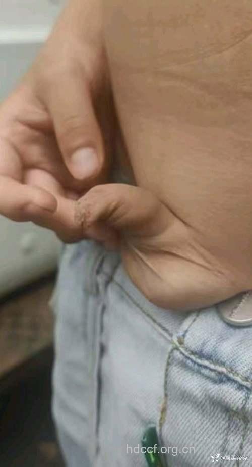 解疑:割包皮的术前术后