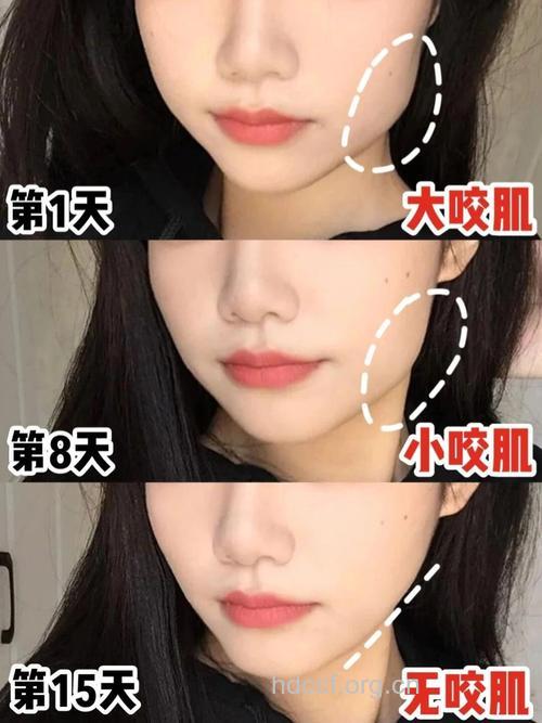 网友亲述打瘦脸针的过程和效果